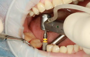 dental implants Adelaide